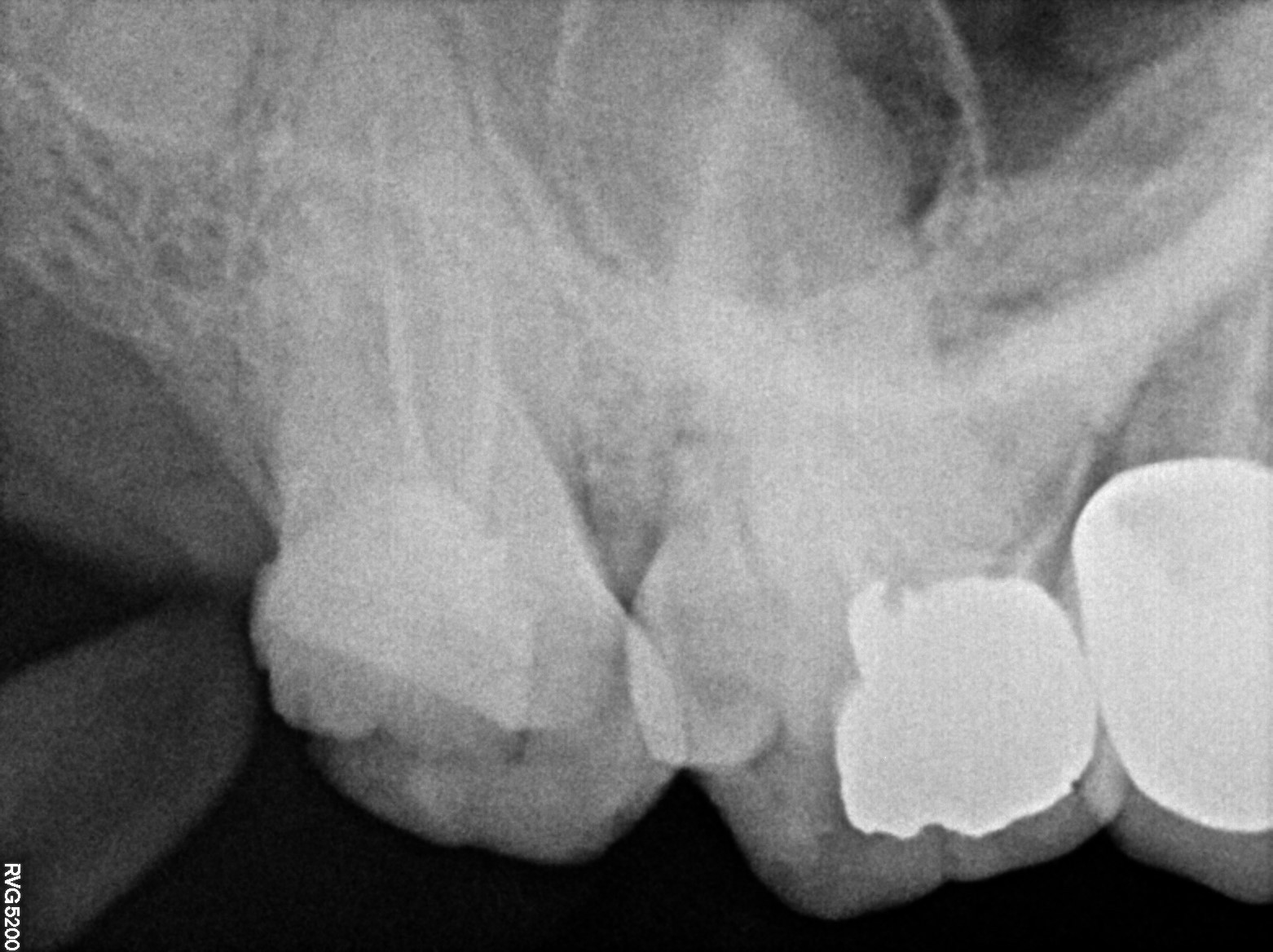 Dental X-ray